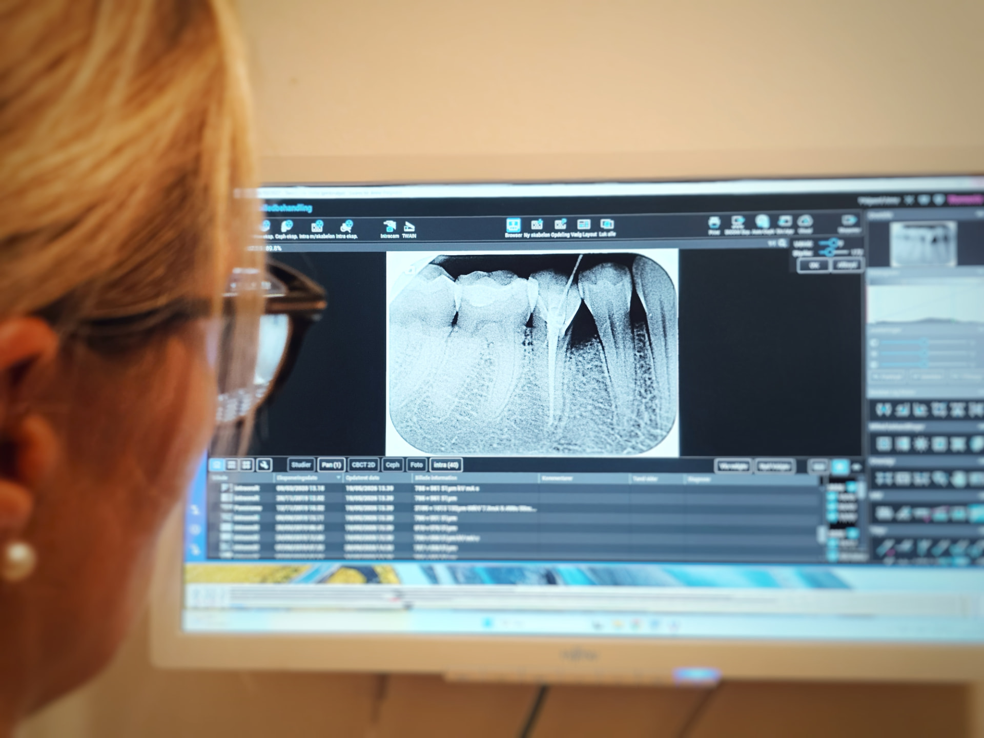 Røntgenbillede af en rodbehandlet tand på klinikkens skærm